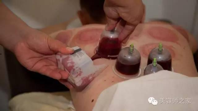 委中放血的方法视频